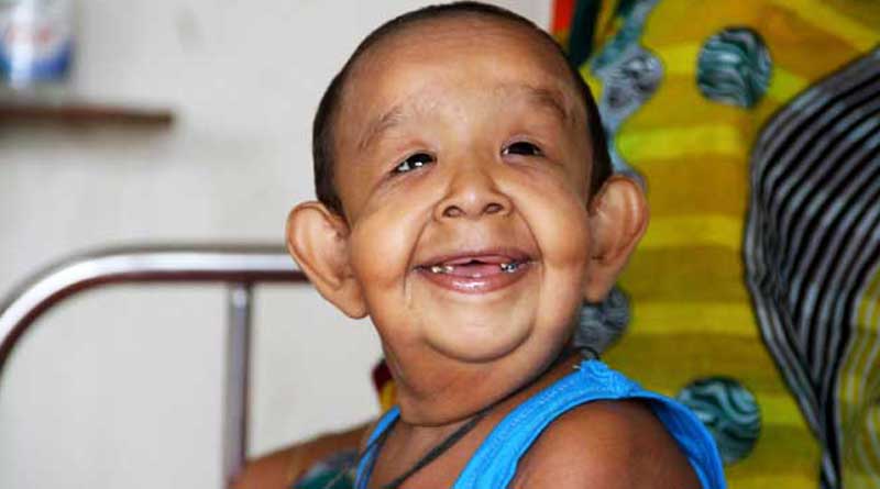 Bangladeshi Boy growing Old, rare disease surprises Doctors