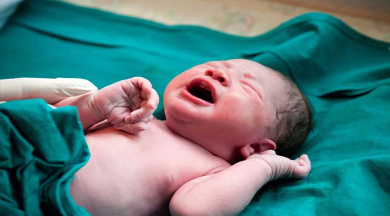 A child born in Maharashtra with Sirenomelia