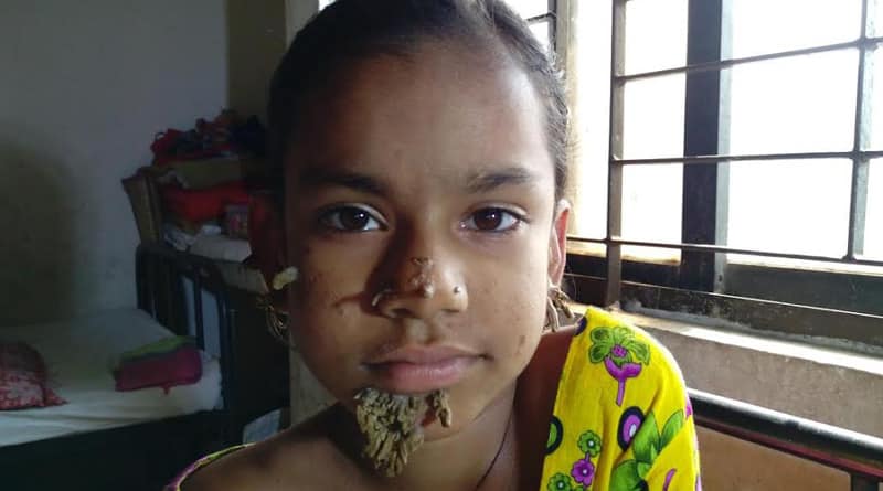 After treeman, rootgirl found in Bangladesh