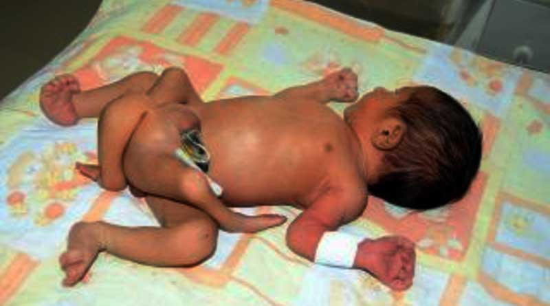 Woman gives birth to child having 4 legs, 2 genitals