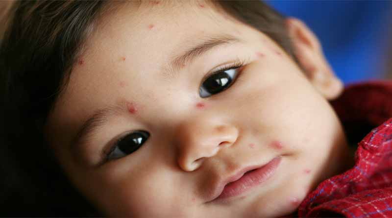 Chicken Pox scare spreads in Bengal