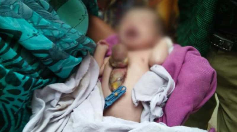 শরীরের বাইরে হৃদপিণ্ড নিয়ে ভূমিষ্ঠ শিশু, তাজ্জব চিকিৎসকরাও