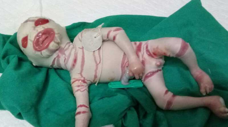  'Harlequin' baby born in Durgapur 