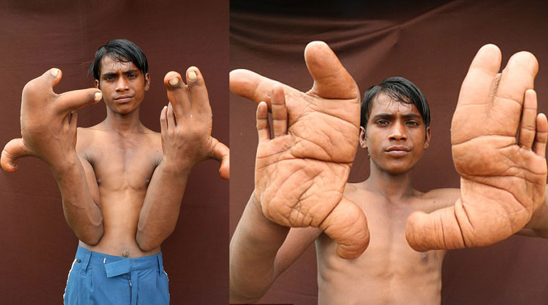 This Indian boy with 12 inch fingers dubbed 'devil'