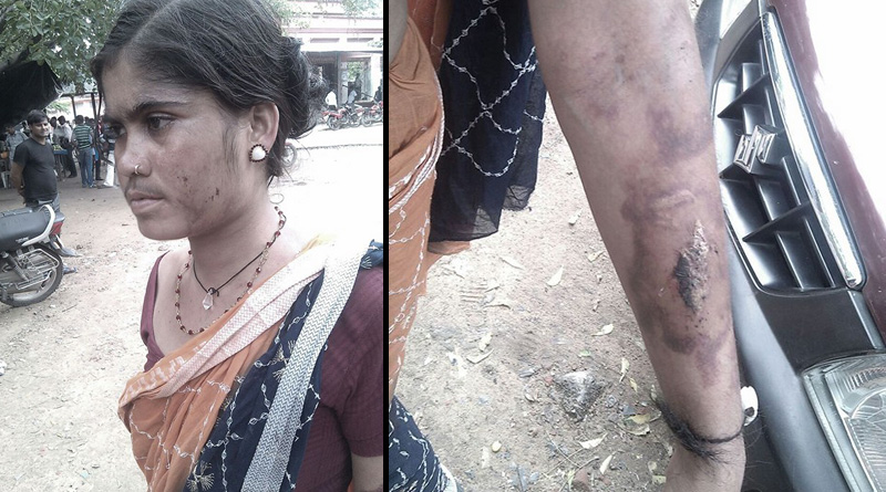 পণের দাবিতে গৃহবধূর গায়ে অ্যাসিড, পলাতক স্বামী ও শ্বশুরবাড়ির লোকজন