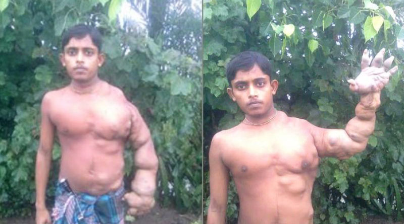 অদ্ভুত রোগের ‘থাবা’, এই যুবকের হাতের ওজন পাঁচ কেজি