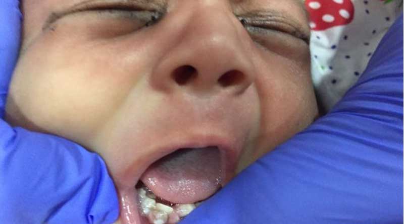 Gujarat: doctors remove seven teeth from newborn