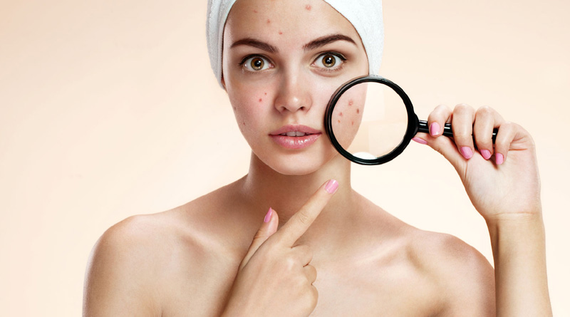 Simple steps to remove acne