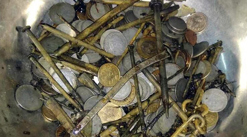 5 kg iron including 263 Coins Found In Madhya Pradesh Man's Stomach