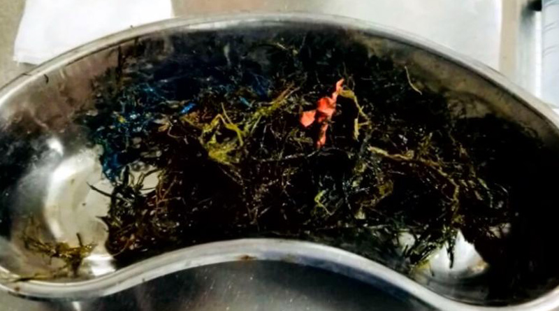 পাকস্থলী ভরতি প্লাস্টিকে, কিশোরের পেটে অস্ত্রোপচারে তাজ্জব চিকিৎসকরা