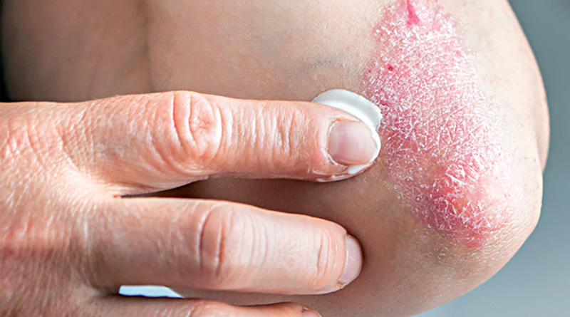 Read how to cure psoriasis