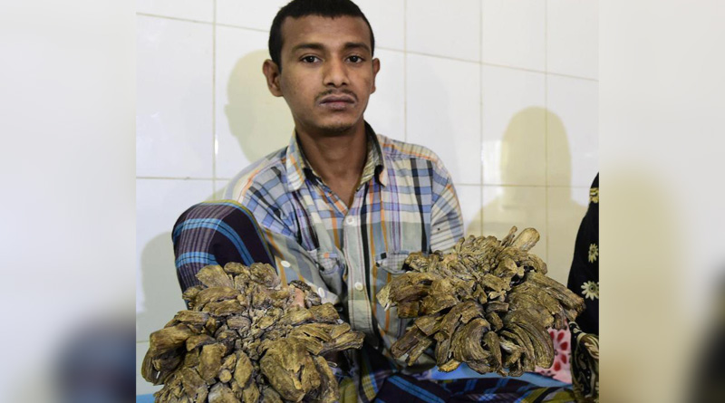 Bangladesh ‘Tree man’s painful warts start regrowing on his hands