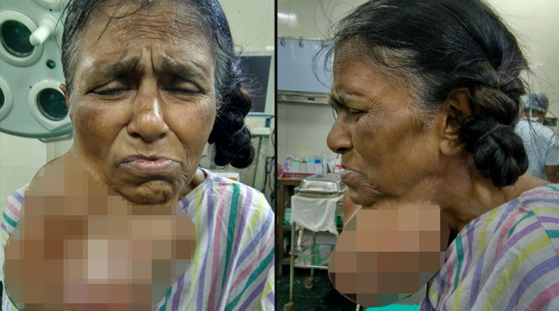 1.7 kg tumour surgically removed from woman’s neck in Nadia