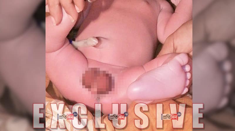 Baby with rare physical deformity born in Kolkata