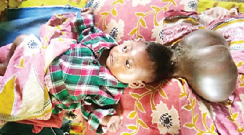 মাথার সঙ্গে আরও একটি মাথা, শিশুকন্যাকে নিয়ে দিশাহারা পরিবার