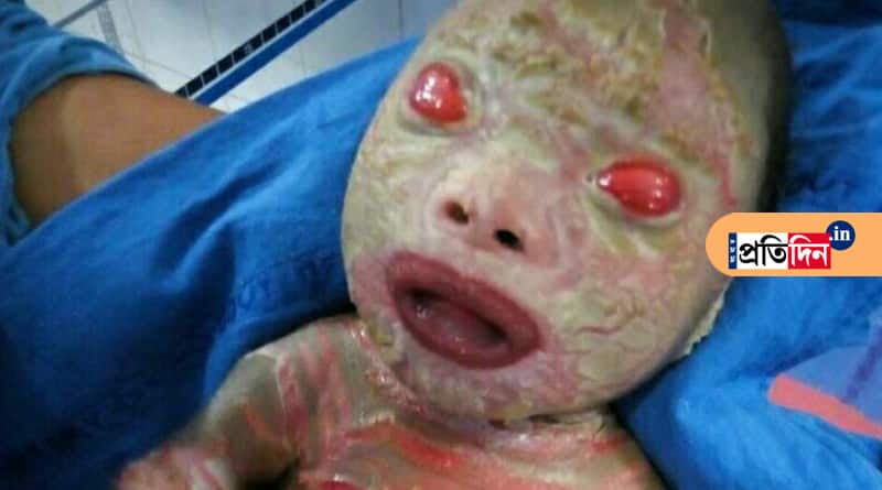 Baby born with Harlequin ichthyosis in Jalpaiguri