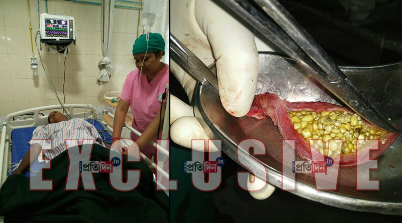পিত্তথলি ও নালি থেকে বেরল ১১১৫টি পাথর, শাপমুক্ত পুরুলিয়ার বৃদ্ধা