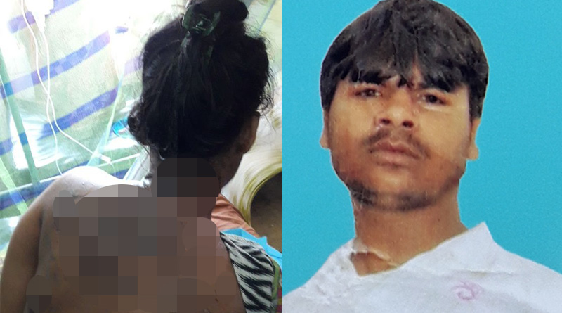 বিয়ের দুদিন আগেই শ্যালিকাকে অ্যাসিড ছুড়ে মারল যুবক