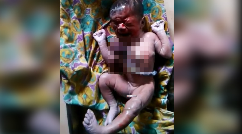 শরীরের বাইরে হৃৎপিণ্ড নিয়ে জন্ম, বাঁচানো গেল না মেদিনীপুরের বিরল শিশুকে