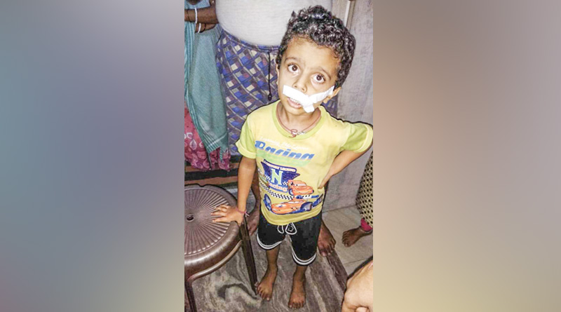 আঘাত ঠোঁটে, যৌনাঙ্গে অস্ত্রোপচারের জন্য শিশুকে ক্যাথিটার পরালেন চিকিৎসক