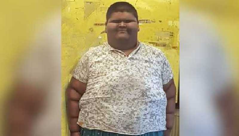 At 236 kg, Delhi boy to undergo weight reduction surgery