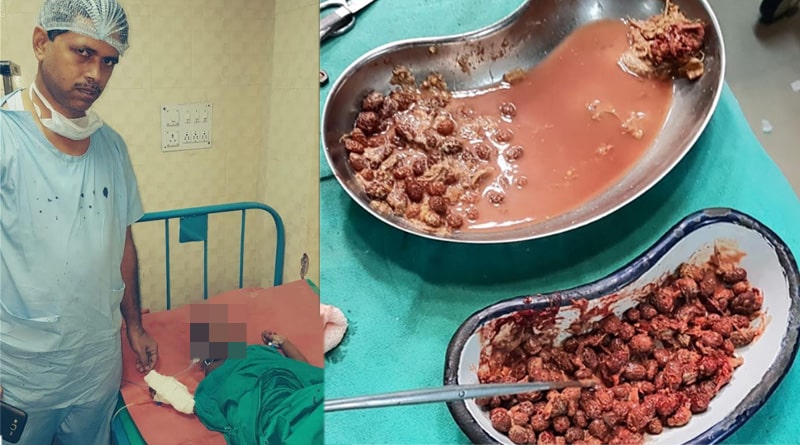অস্ত্রোপচারে সাফল্য, চার বছরের খুদের পেট থেকে বেরোল ২০৩টি কুলের আঁটি