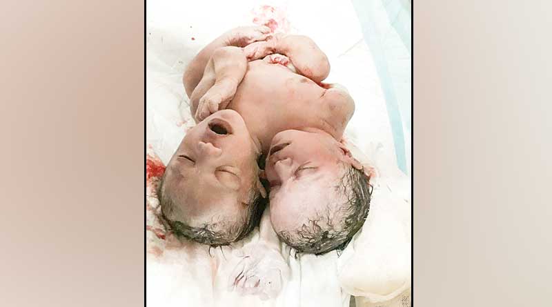 Conjoined twins died in CNMC