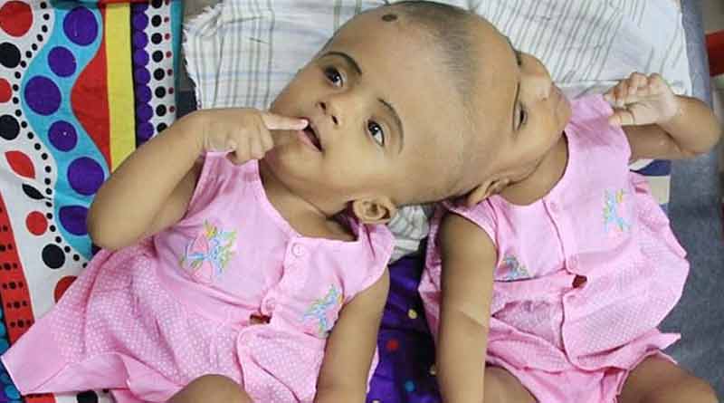 জোড়া মাথা নিয়ে জন্ম, অস্ত্রোপচারের জন্য হাঙ্গেরি যাত্রা যমজ শিশুর