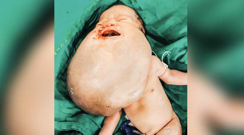 বিরল ঘটনা, মেডিক্যাল কলেজে জন্মাল ‘জায়ান্ট ফেস’ শিশু