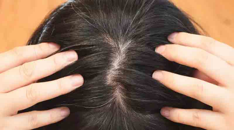 Tips to prevent grey hair at early age