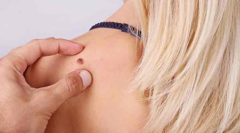 Home remedies to destroy warts