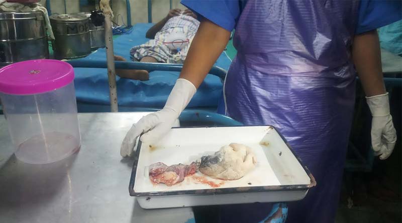 A foetus is found within a child’s belly, surgery done at Burdwan