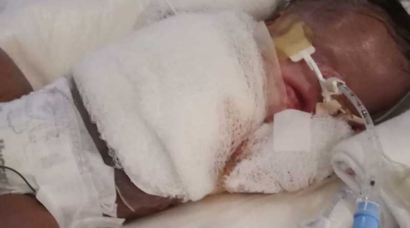Doctors struggle to save baby born with nearly no skin
