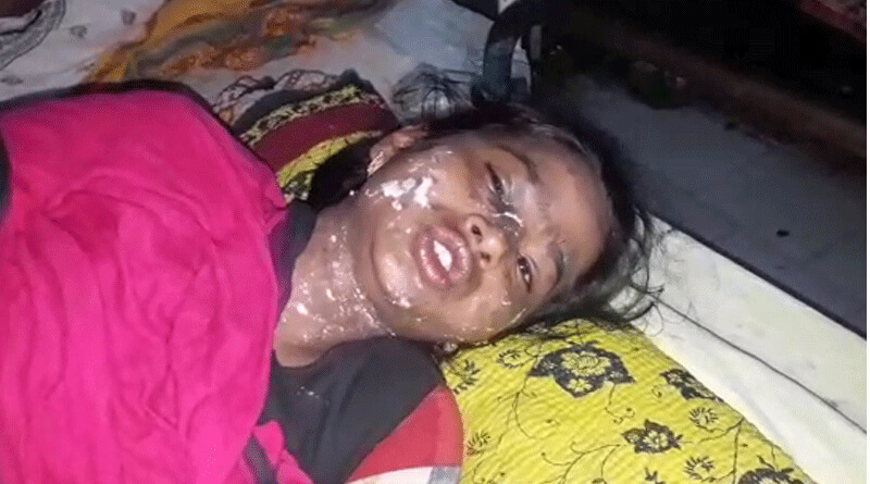 Acid attack on class 10 student at Kandi in Murshibadab