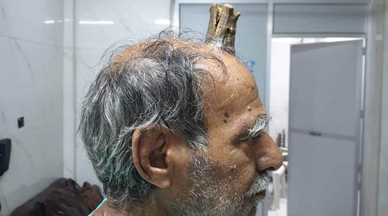 Madhya Pradesh: 74-year-old man grew devil’s horn after injury