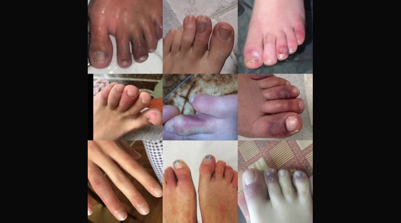 Covid toes is new symptom of novel coronavirus infection, says experts