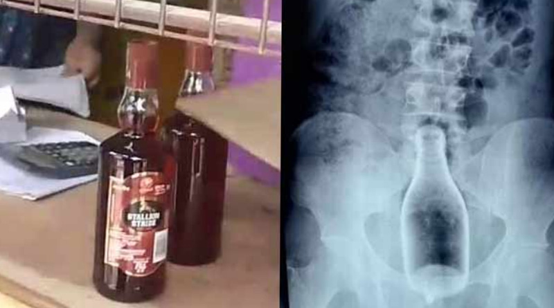 TN: Drunk man inserts liquor bottle in rectum, doctors surgically remove it