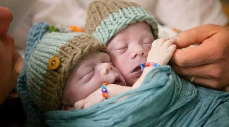 A twin with one heart died after 24 hours of their birth in Kolkata