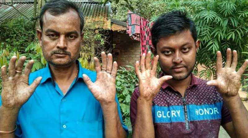 The men in this Bangladeshi family have no fingerprints | Sangbad Pratidin