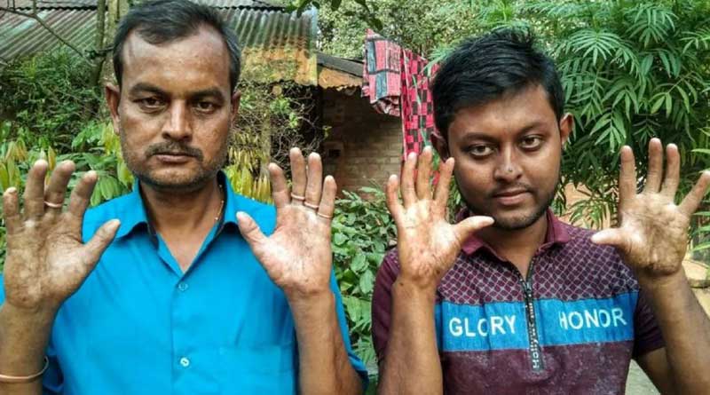 আঙুল আছে, অথচ ছাপ নেই! বিস্ময়ের নিদর্শন এই বাংলাদেশি পরিবার