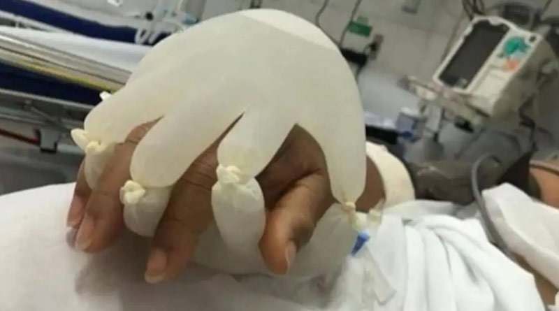Brazil nurses make new gloves to comfort COVID-19 patients, video goes viral |Sangbad Pratidin