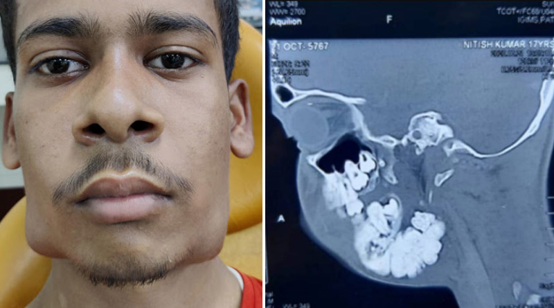 Bihar Teenager Nitish Kumar Gets 82 Teeth Removed in Rare Surgery | Sangbad Pratidin