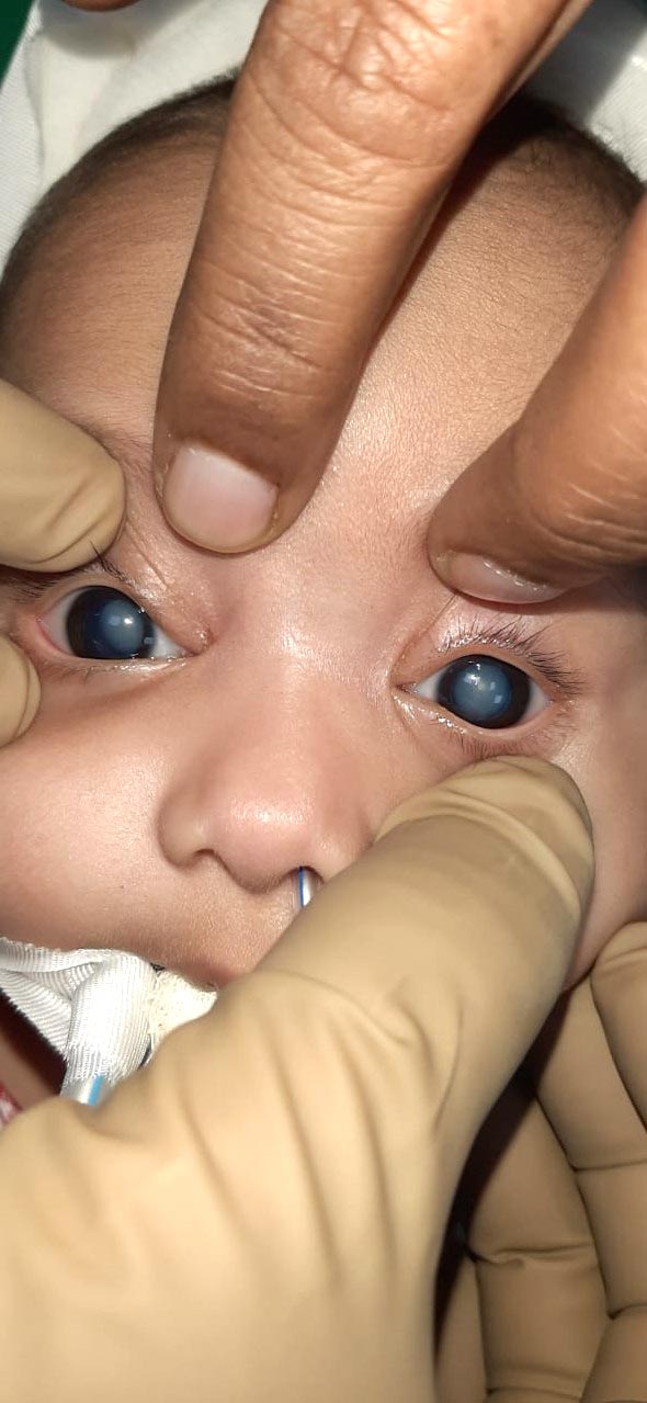 Congenital Total Cataract increasing in children 