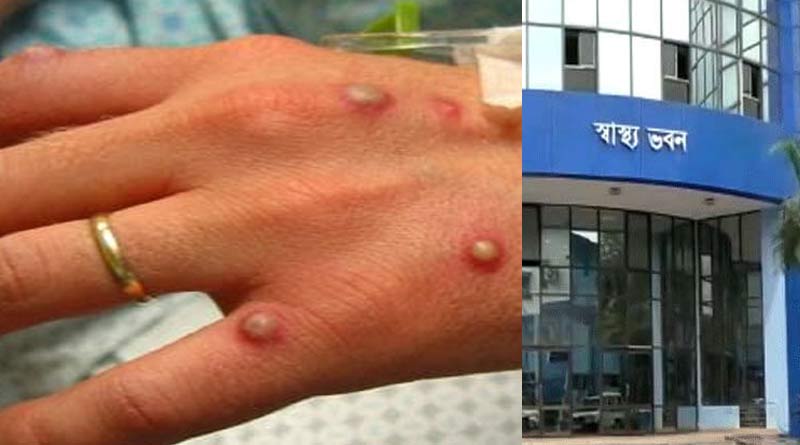 Amidst Monkeypox spread, West Bengal Health Department allerts and instructs hospitals to be prepared | Sangbad Pratidin