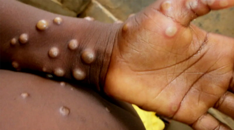 Monkeypox cases spread 