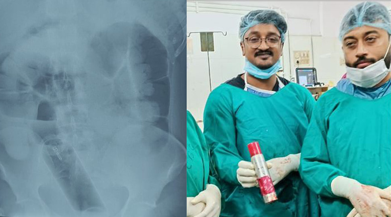 Young man from Burdwan inserts deodorant bottle in his rectum | Sangbad Pratidin