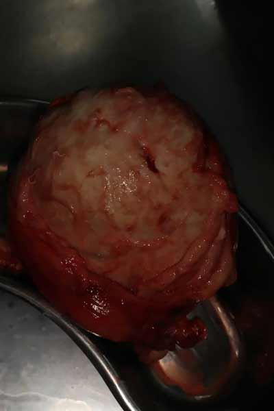 Tumor