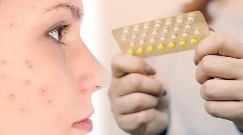 Can birth control pills help reduce acne? | Sangbad Pratidin