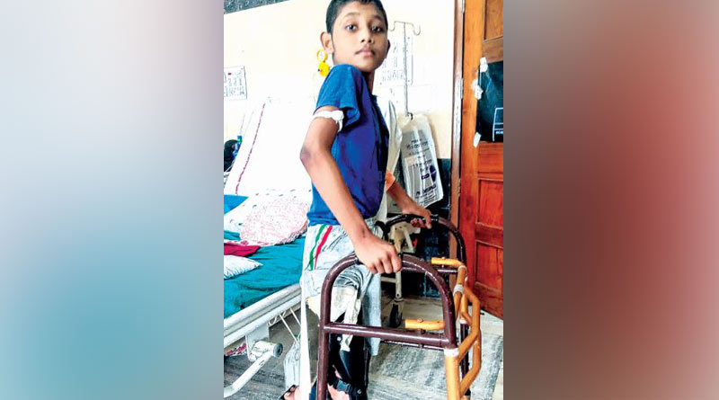 SSKM conducts rotationplasty, first time as government hospital | Sangbad Pratidin