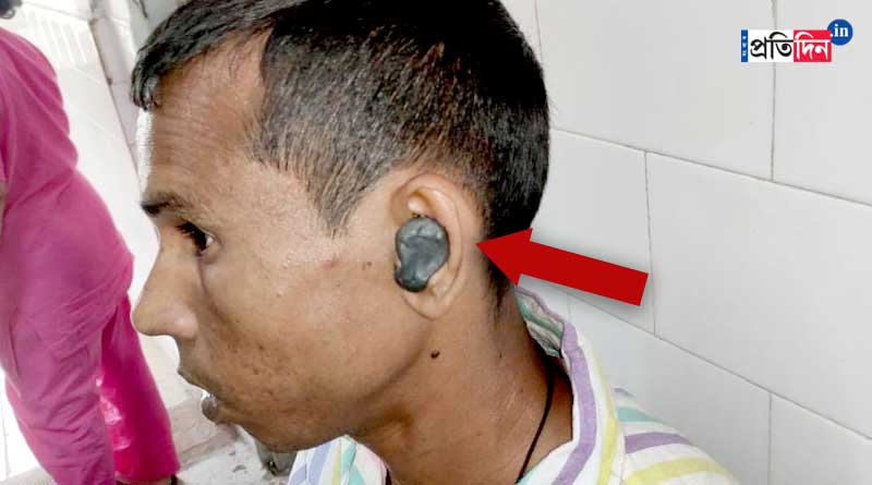Man uses Mseal to clean ears worth 20 rupees | Sangbad Pratidin